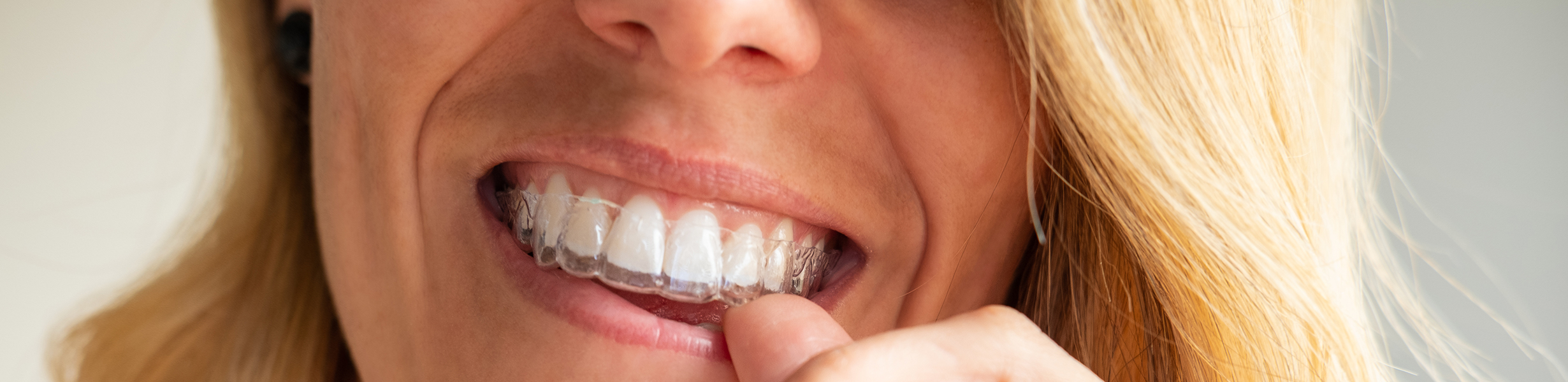Bruxism Night Guards The Tooth Company Orthodontics