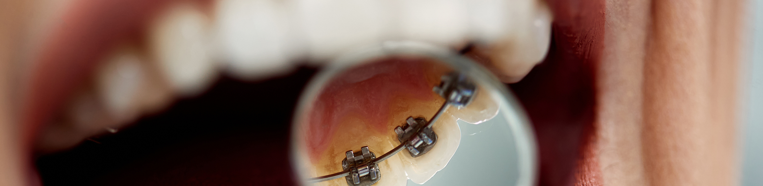 Incognito “Lingual braces” The Tooth Company Orthodontics